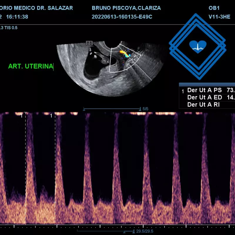 ECOGRAFIA DOPPLER