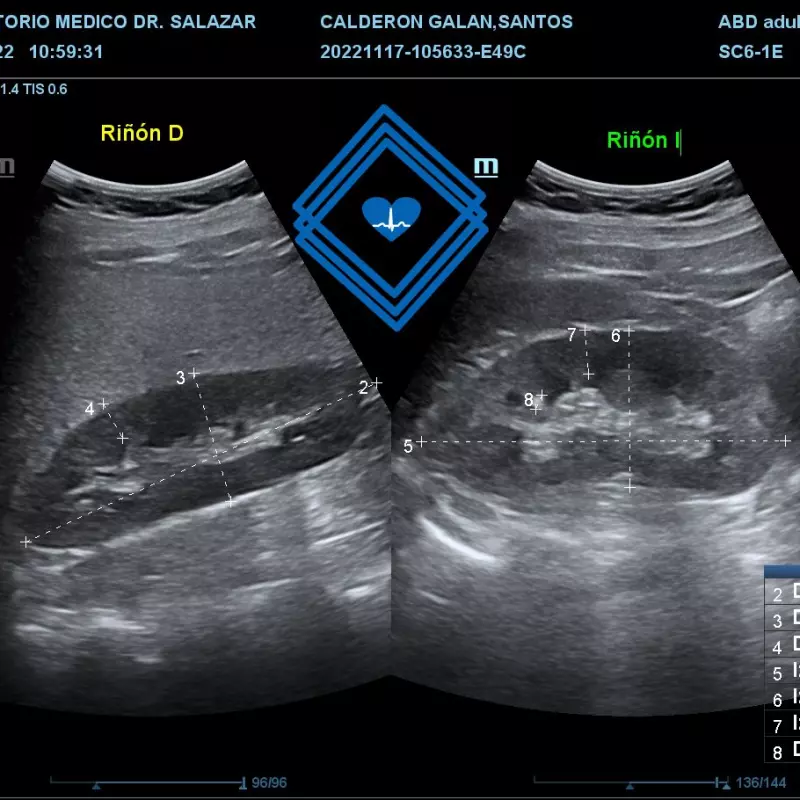 ECOGRAFIA RENAL