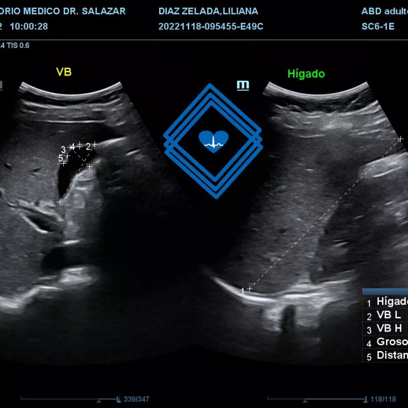 ECOGRAFIA ABDOMINAL